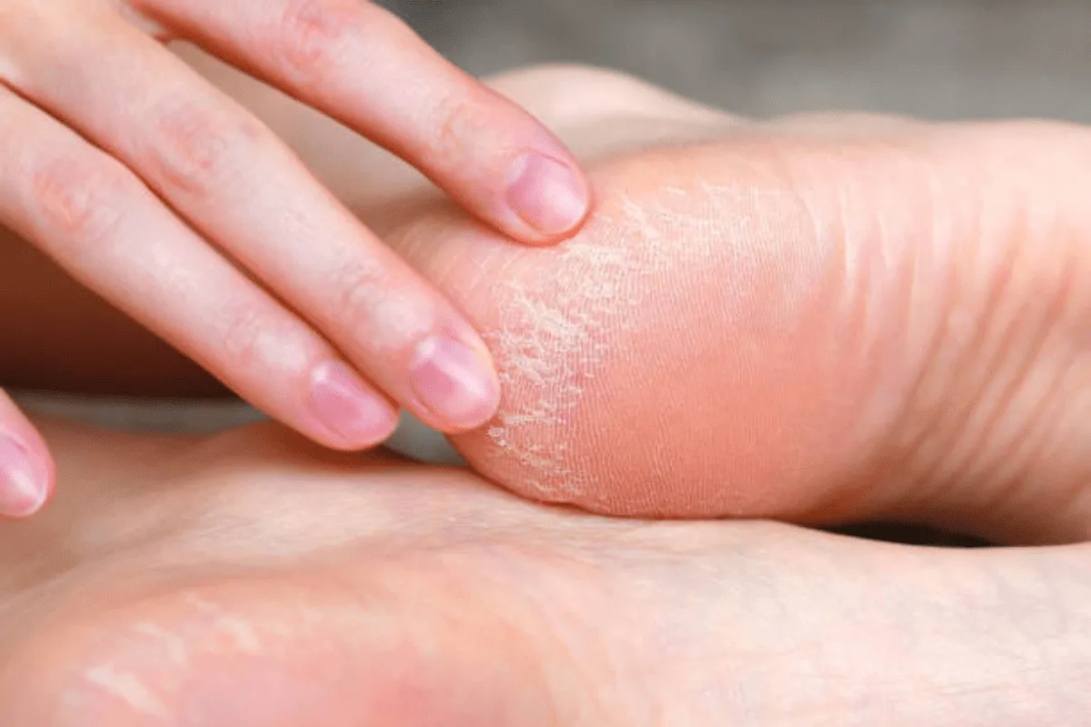 العناية بالقدمين من التشققات