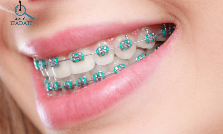 ألوان تقويم الأسنان