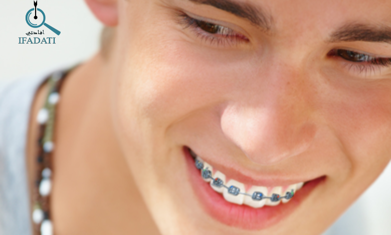ألوان تقويم الأسنان