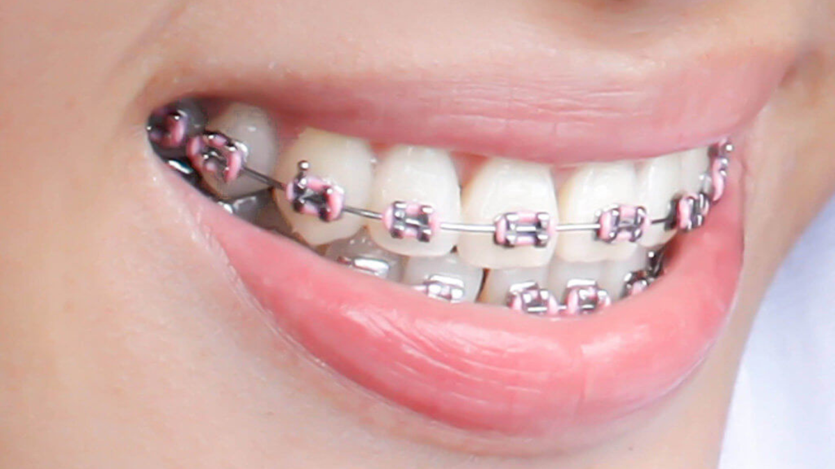 ألوان تقويم الأسنان