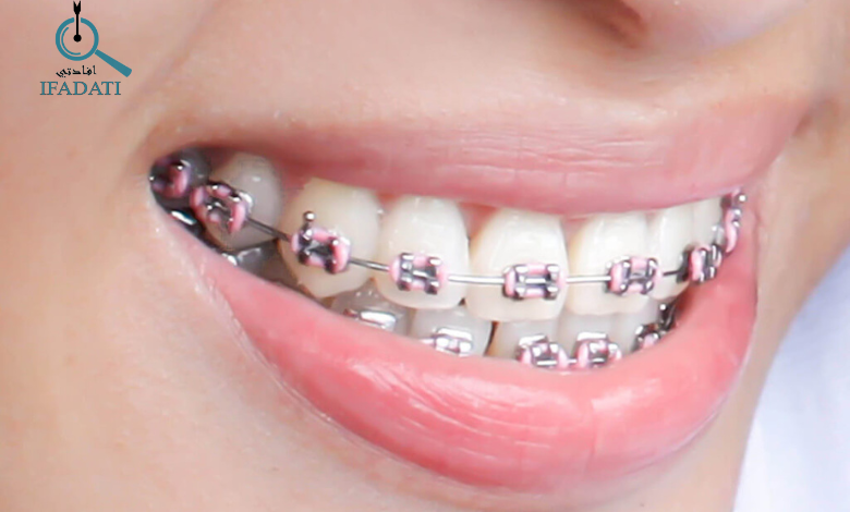 بريسز الاسنان 1