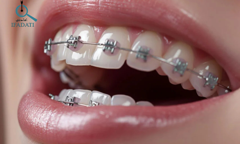 بريسز الاسنان 2