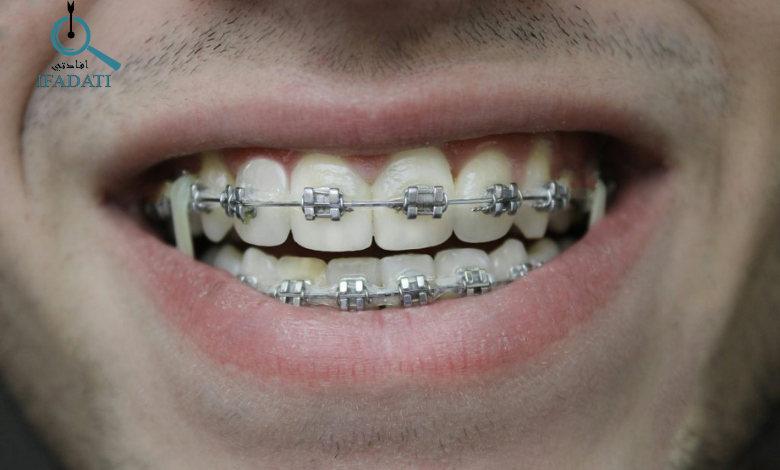 بريسز الاسنان