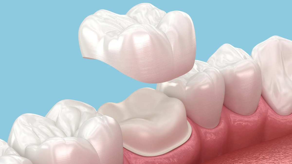 تاج الاسنان