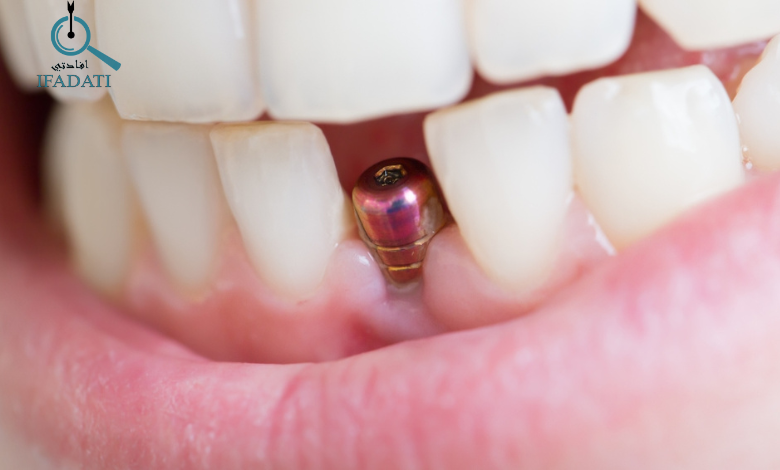 هل زراعة الاسنان مؤلمة