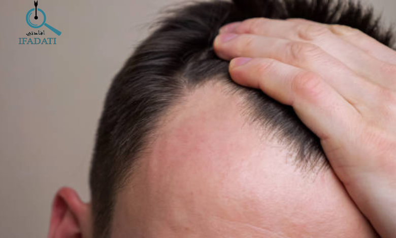 سبب تساقط الشعر بكثره