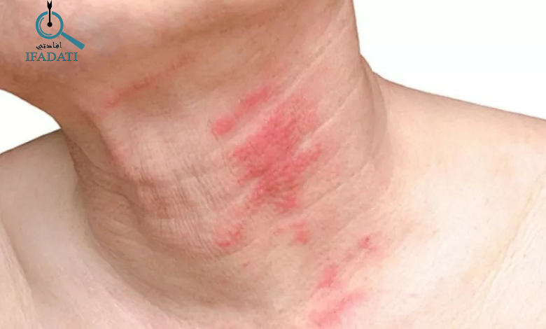 اعراض الحزام الناري