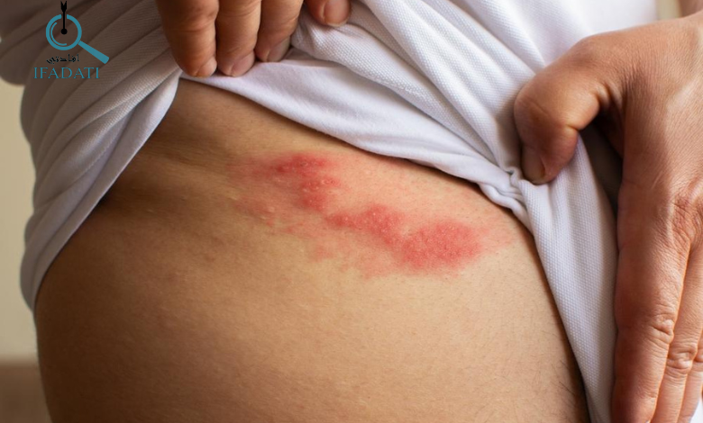 اعراض الحزام الناري
