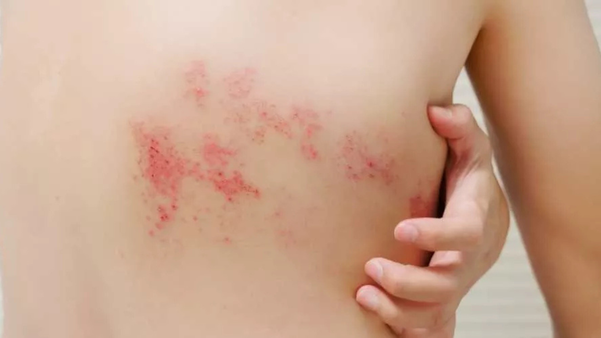 اعراض الحزام الناري