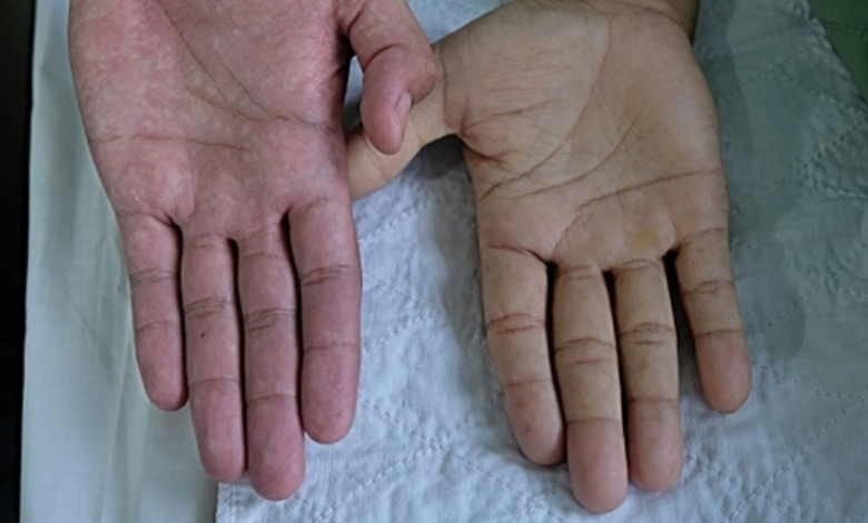 كيف أعرف فقر الدم من اليد