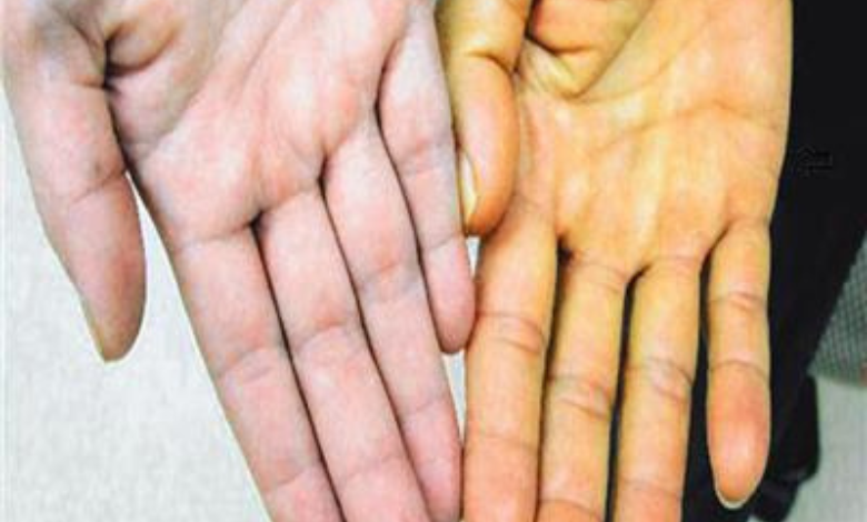 كيف أعرف فقر الدم من اليد