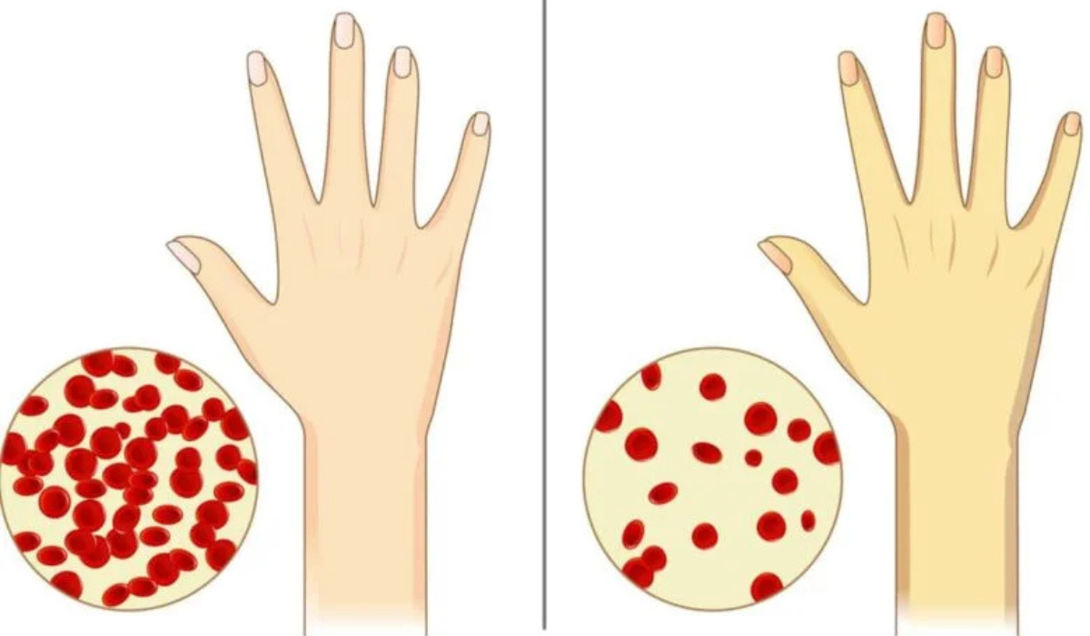 كيف أعرف فقر الدم من اليد